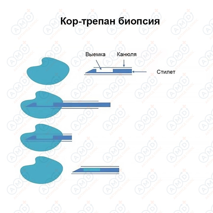 Игла_биопсийная_SuperCore_05_720_720